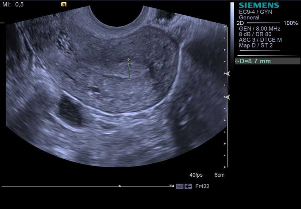 Эндометрий 10мм. УЗИ матки измерения размеров. УЗИ малого таза яичники матка. Измерение шейки матки на УЗИ.