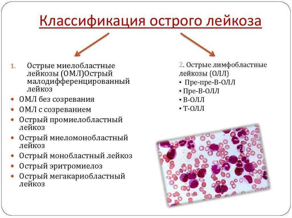 Острый лимфолейкоз презентация