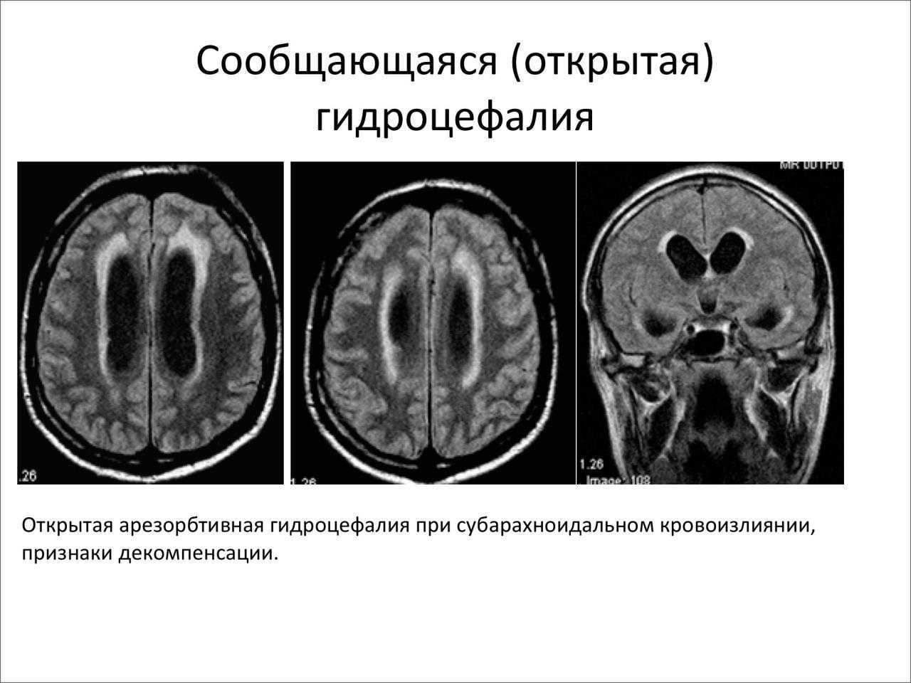 Гипоксия новорожденного: симптомы, реабилитация, последствия