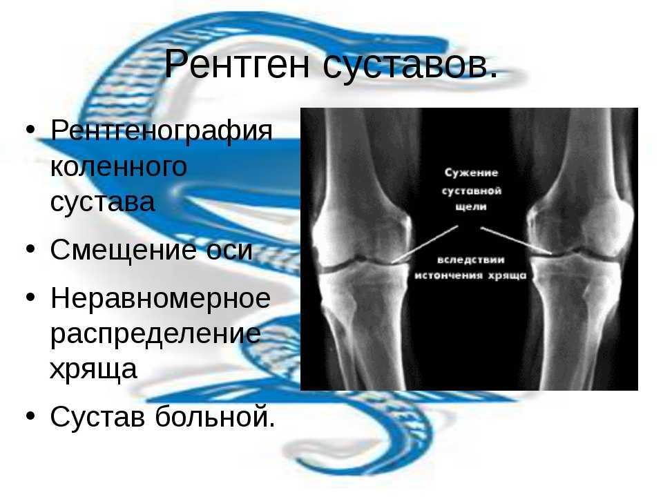 Рентген колена. Расшифровка рентгена коленного сустава. ТЭП коленного сустава рентген. Расшифровка рентгеновских снимков коленного сустава. Коленный сустав в 2 проекциях рентген.