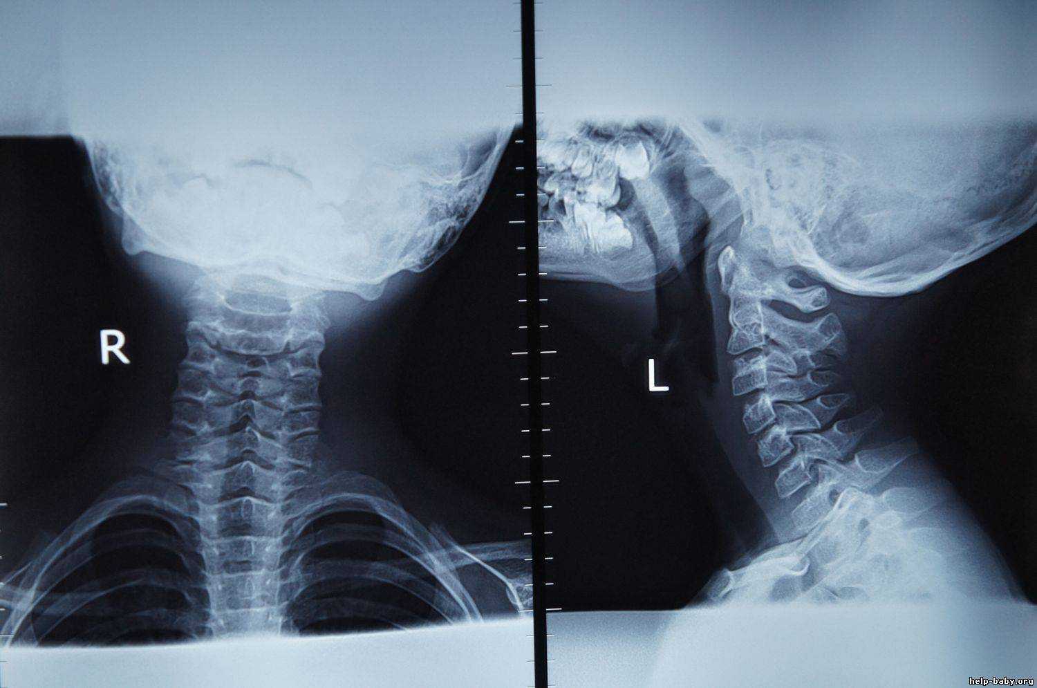 Рентген шейного отдела норма