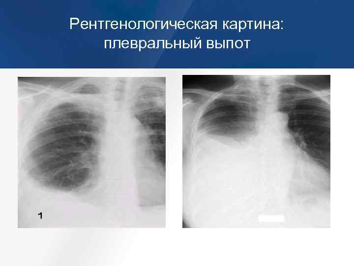 Почему на рентгеновском снимке изображение газа в плевральной полости черное