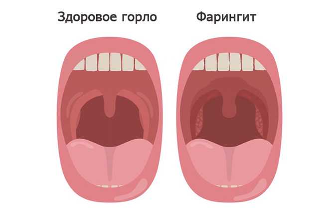Липа при беременности, её польза, противопоказания и риски употребления