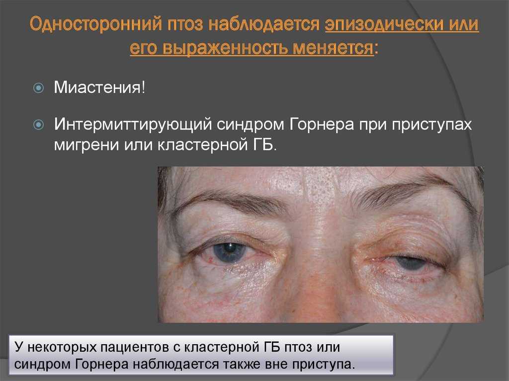 Миастения