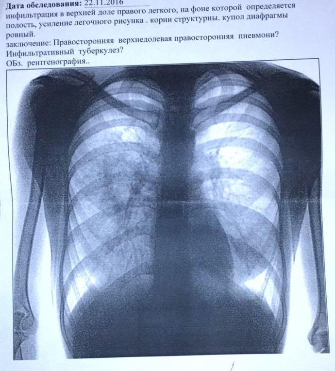 Усиление легочного рисунка на флюорографии что значит у взрослого