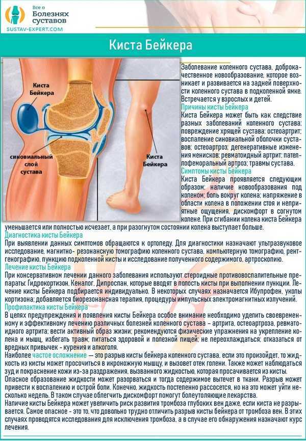 Ревматоидный коленный сустав: киста Бейкера, сгибательные деформации. Бейкера киста Бейкера коленного сустава.