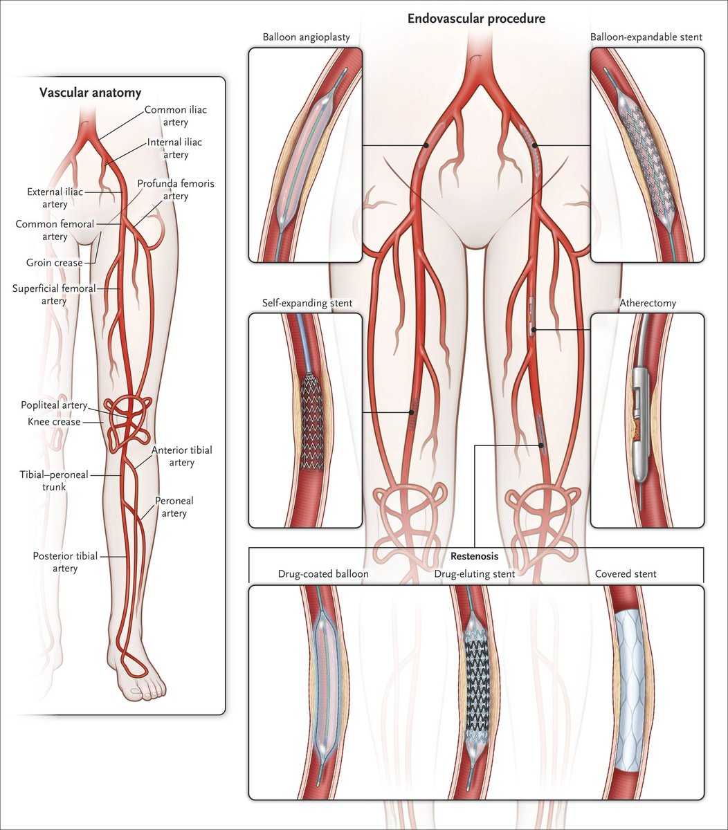 Место ангиопластики при лечении окклюзированных (длиной более 10 см) бедренных артерий.