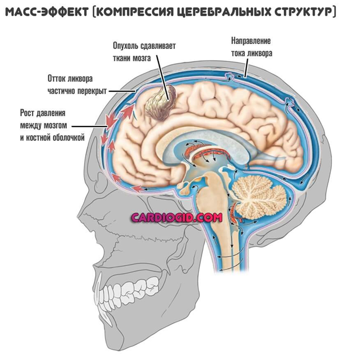 Сдавливание головного мозга. Ликвор в головном мозге. Отток ликвора из головного мозга. Церебральные структуры это.