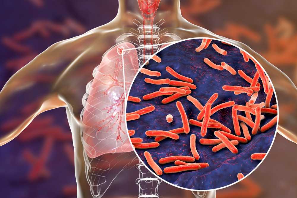Туберкулез - заболевание, которое в современных условиях и достижениях науки легко диагностировать