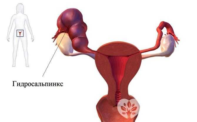 Заболевания репродуктивной системы у женщин. симптомы, диагностика, виды лечения