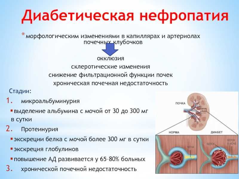 Диабетическая нефропатия картинки