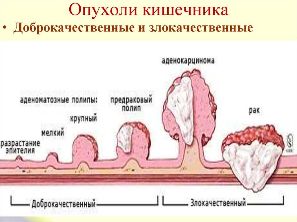 Зубчатая аденома толстой кишки