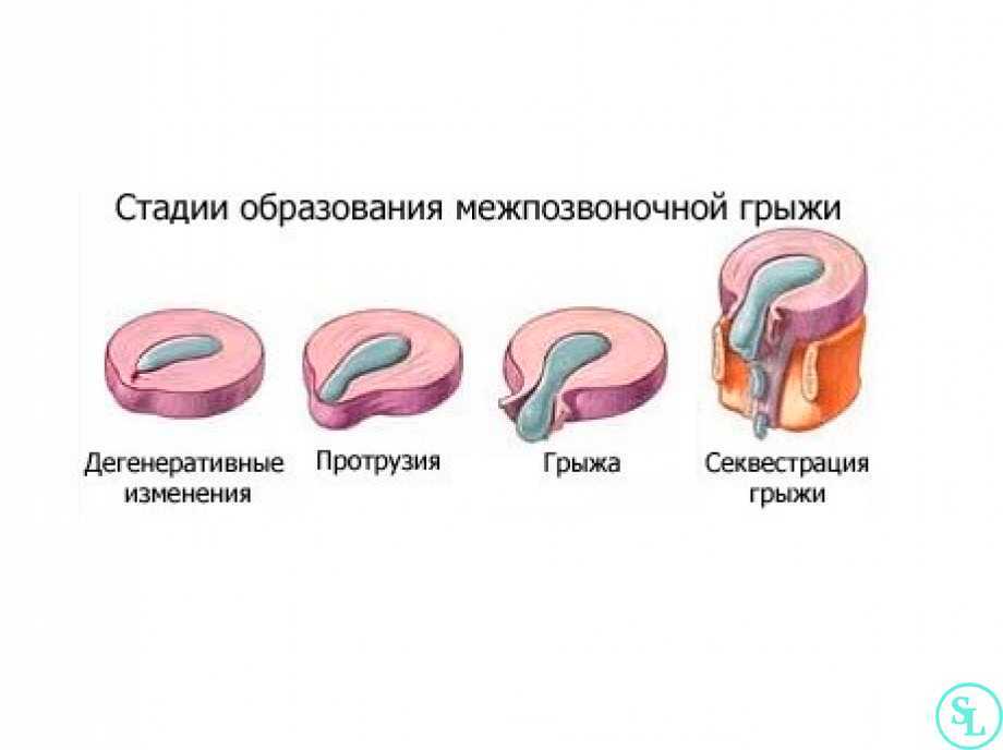 Протрузия дисков