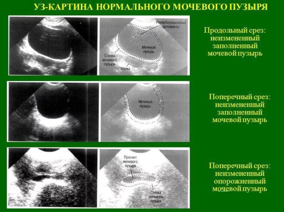 Мочевой пузырь узи можно есть. Стенка мочевого пузыря норма по УЗИ. Толщина стенки мочевого пузыря УЗИ. УЗИ мочевого пузыря показатели в норме. Нормальная эхограмма мочевого пузыря.