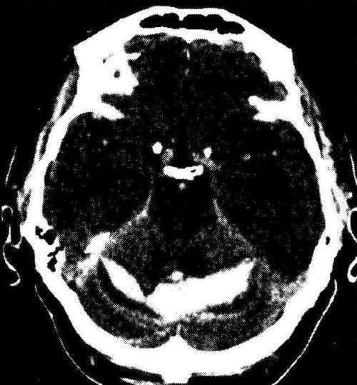 Запись на кт. Гематома задней черепной ямки. Субдуральная гематома по намету мозжечка кт. Субдуральная гематома задней черепной ямки кт.