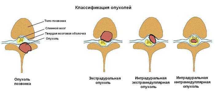 Спинальный инсульт: признаки, симптомы и лечение последствий | ким