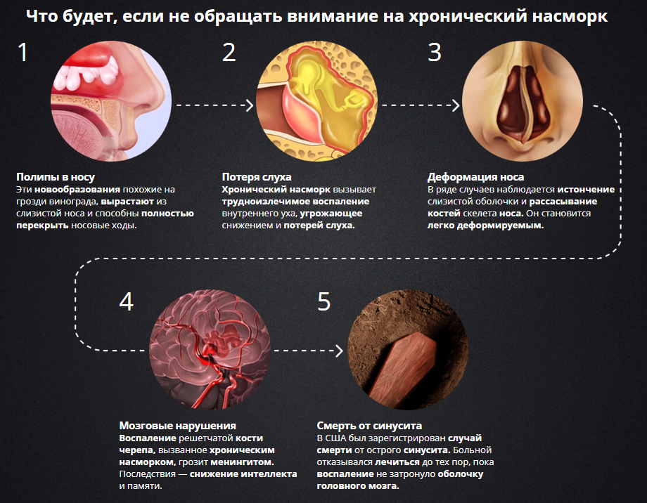 Ринит: симптомы и лечение