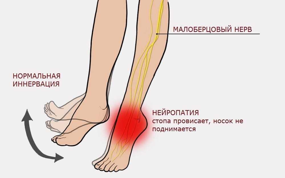 Тендинит: симптомы, лечение и профилактика опасного заболевания суставов и связок | артракам