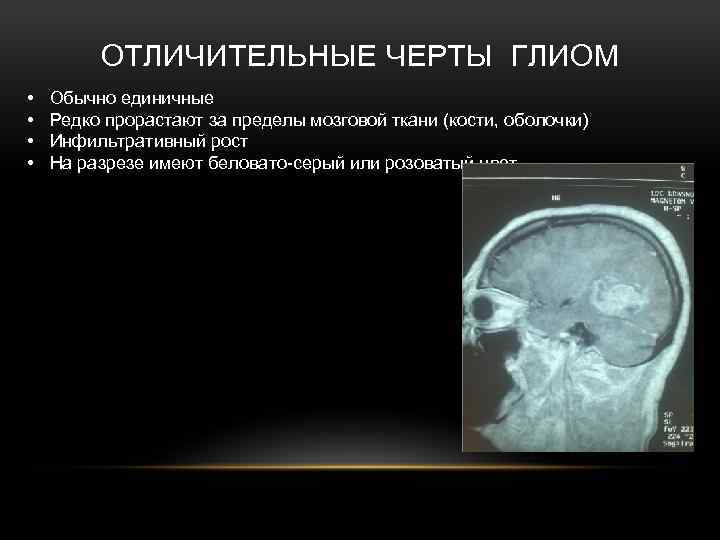Что такое глиома. Диффузная глиома головного мозга. Глиома опухоль головного мозга симптомы. Глиома мозгового ствола.