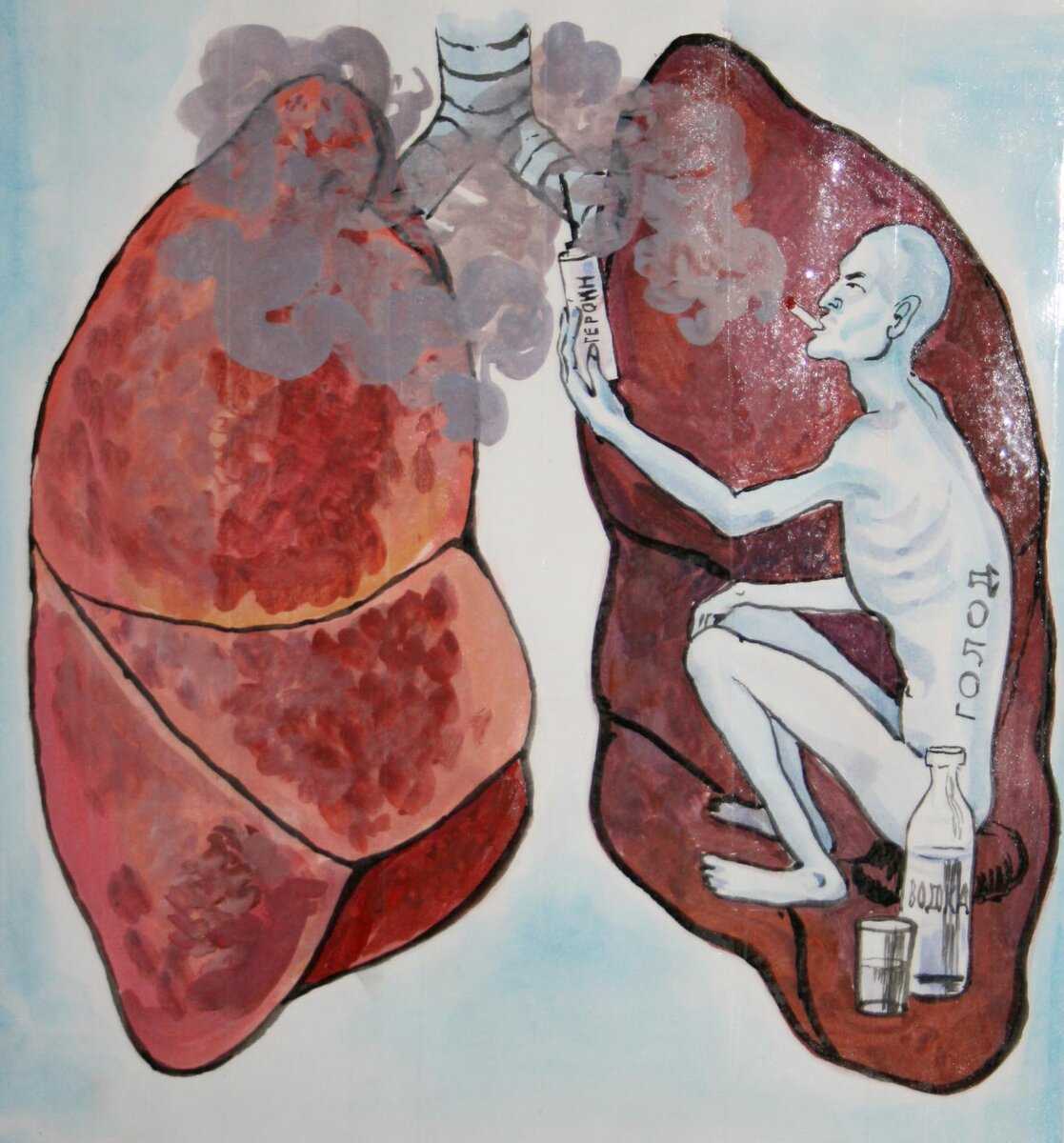 Диагностика туберкулеза: проба манту или диаскинтест