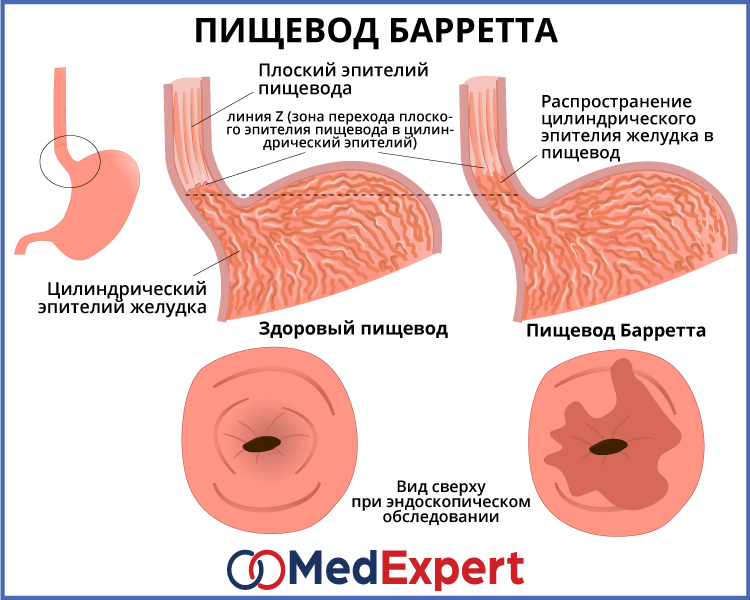 Эрозивный бульбит лечение препараты схема