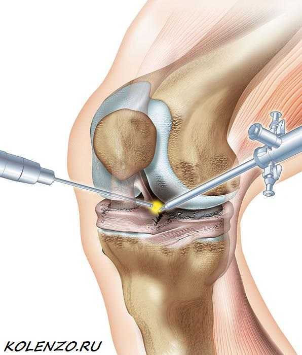 Артроскопическая операция коленного сустава. Артроскопия мениска коленного сустава. Операция артроскопия коленного сустава. Артроскопическая резекция мениска коленного.