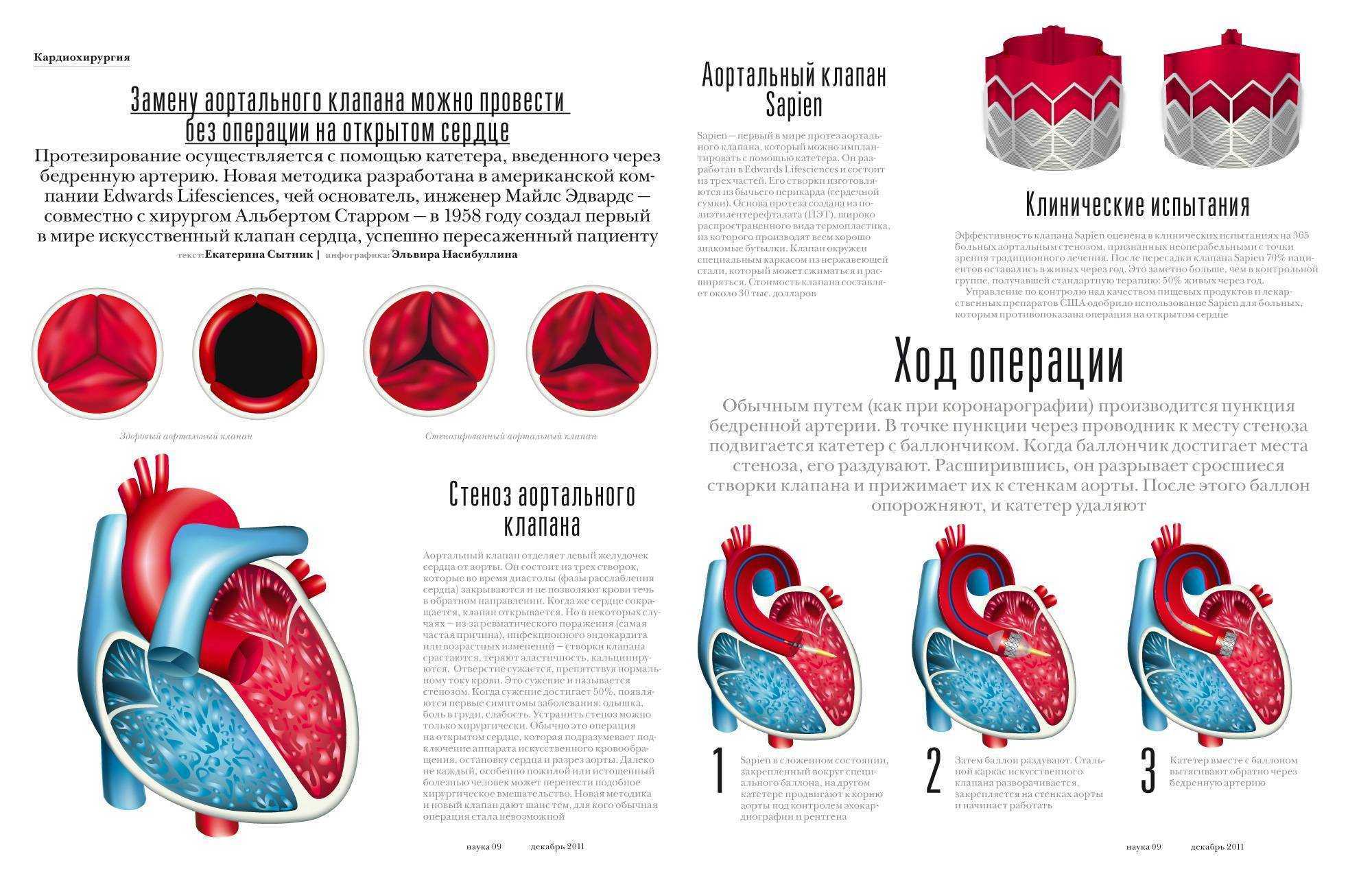 Замена сердца