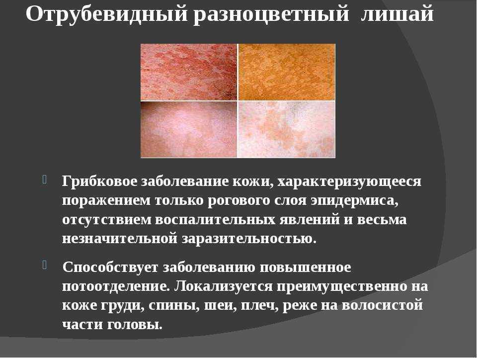 Невралгия тройничного нерва