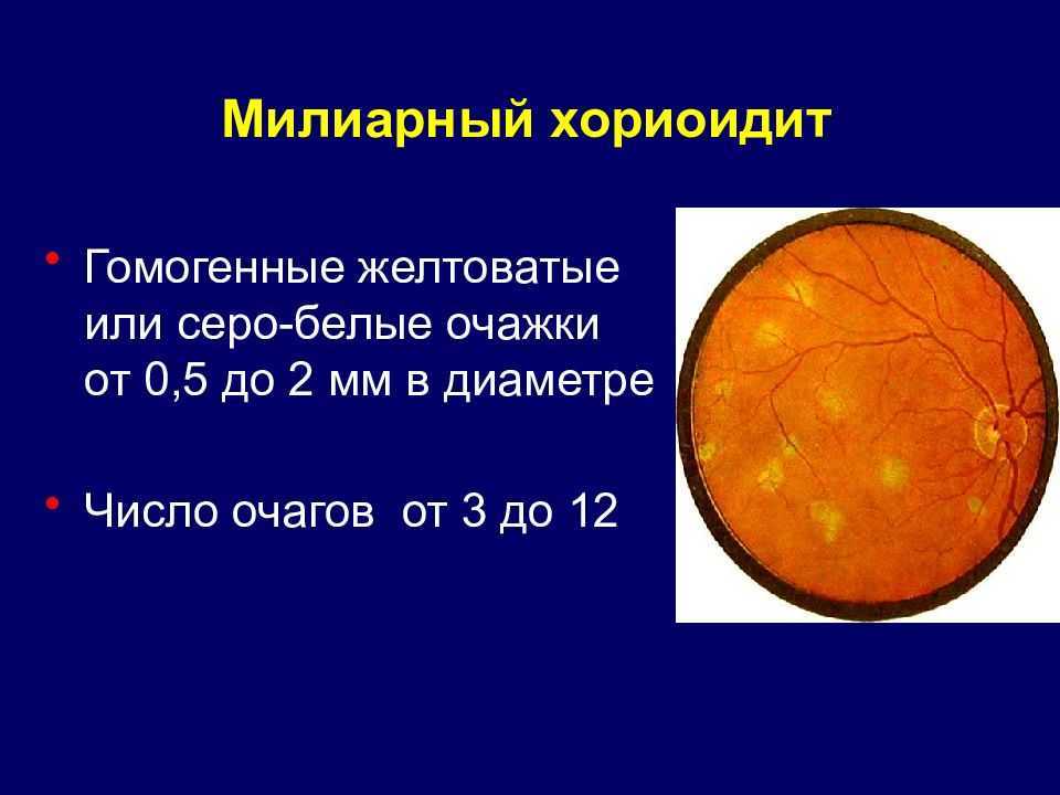 Хориоидея - википедия