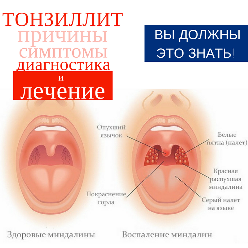 ангина как выглядит в горле