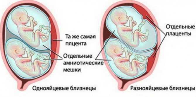 Признаки многоплодной беременности на ранних сроках