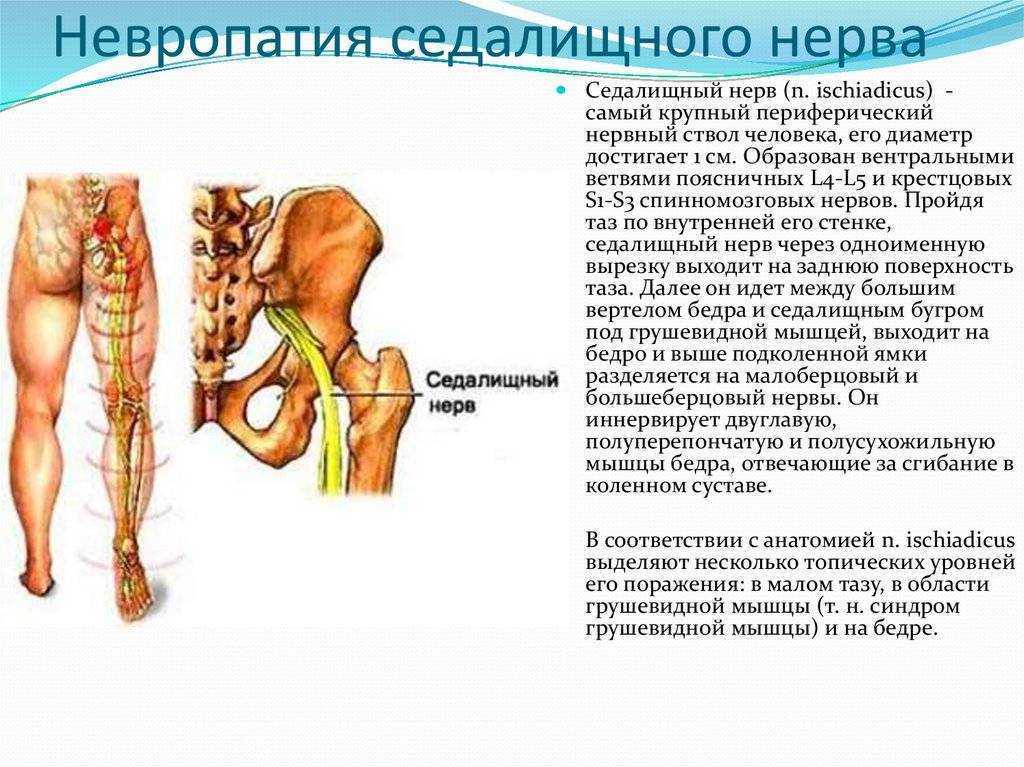 Схема лечения ишиаса