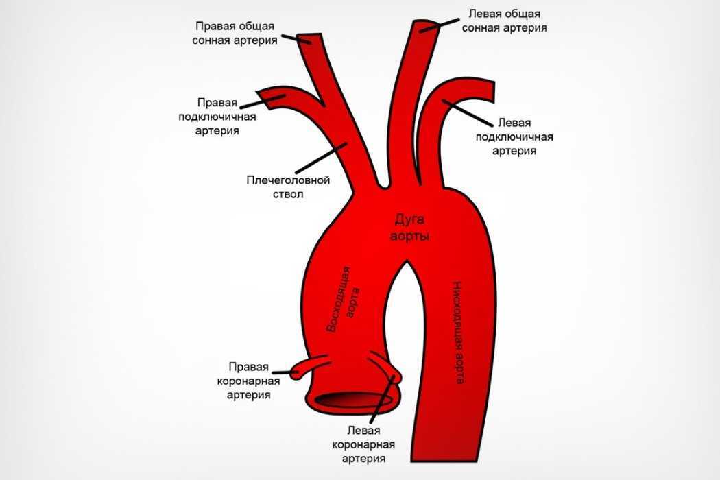 Атеросклероз дуги аорты