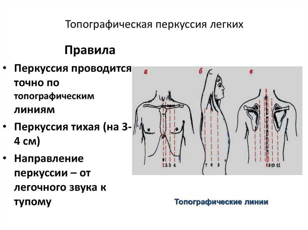 Схема сравнительной перкуссии легких