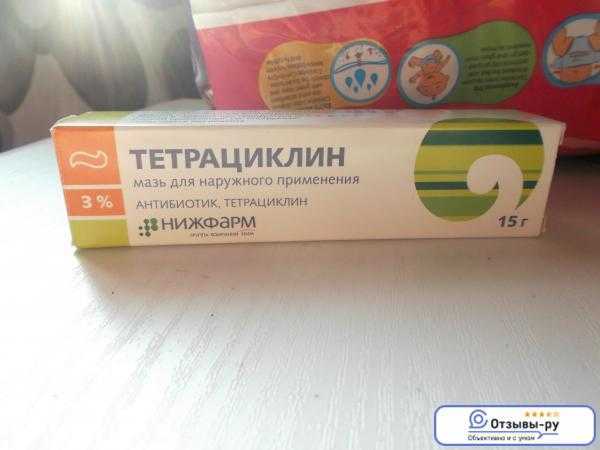 Лечение парапроктита
