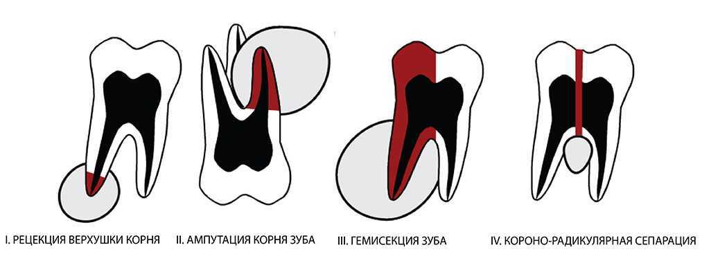Схема резекции верхушки корня