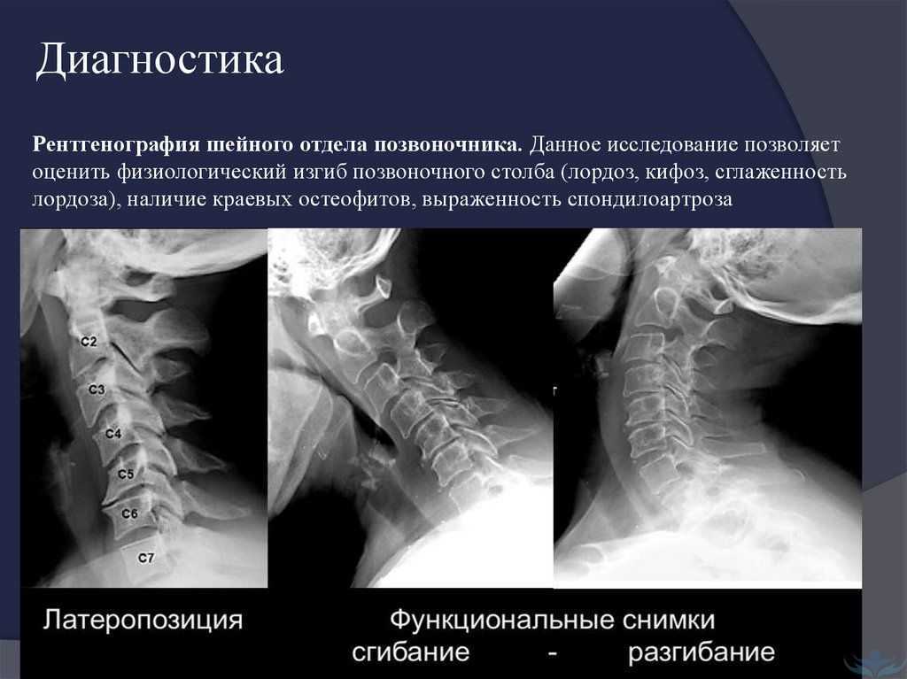 Рентген шейного. Рентген шейного отдела позвоночника с функциональными пробами. Рентген шейного отдела позвоночника сбоку. Шейный отдел позвоночника рентген норма. Патологический кифоз шейного отдела позвоночника рентген.