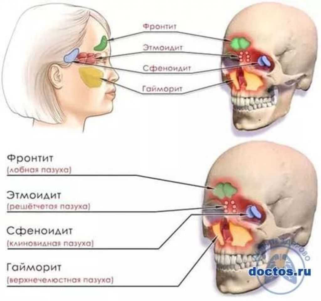 Мр картина сфеноидита