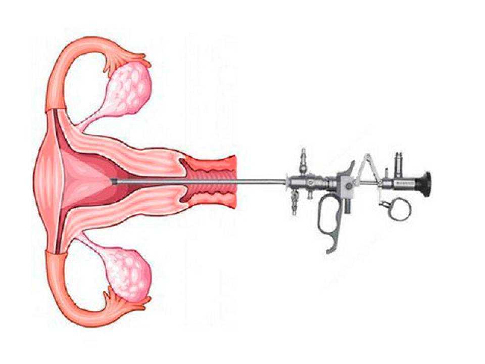 Удаления полипа эндометрия гистероскопией