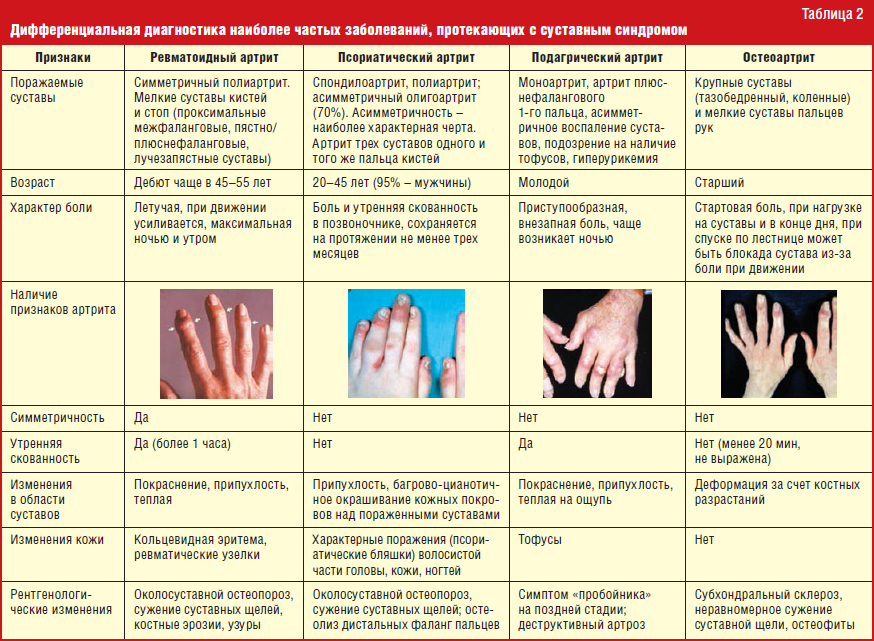Ревматоидный артрит: симптомы и лечение