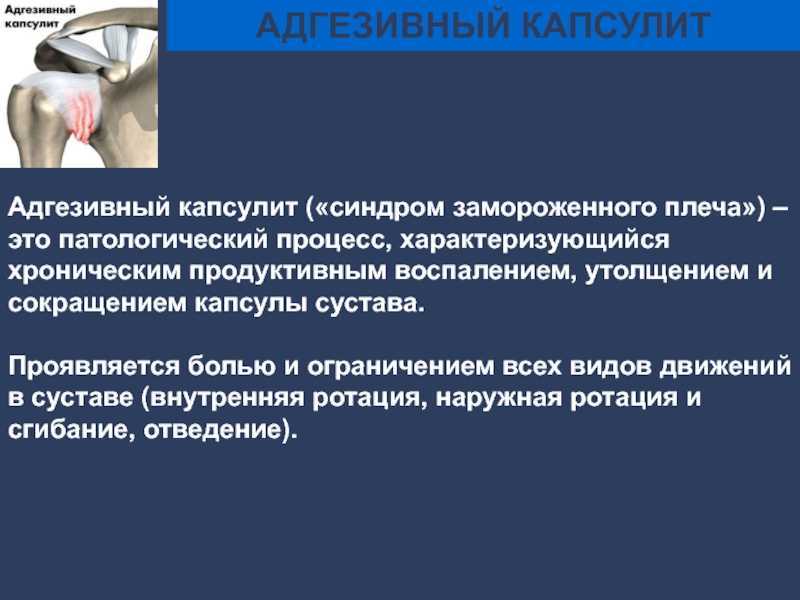 Капсулит плечевого сустава. Капсулит плечевого сустава мрт. Капсулит замороженное плечо. Адгезивный капсулит плечевого сустава мрт.