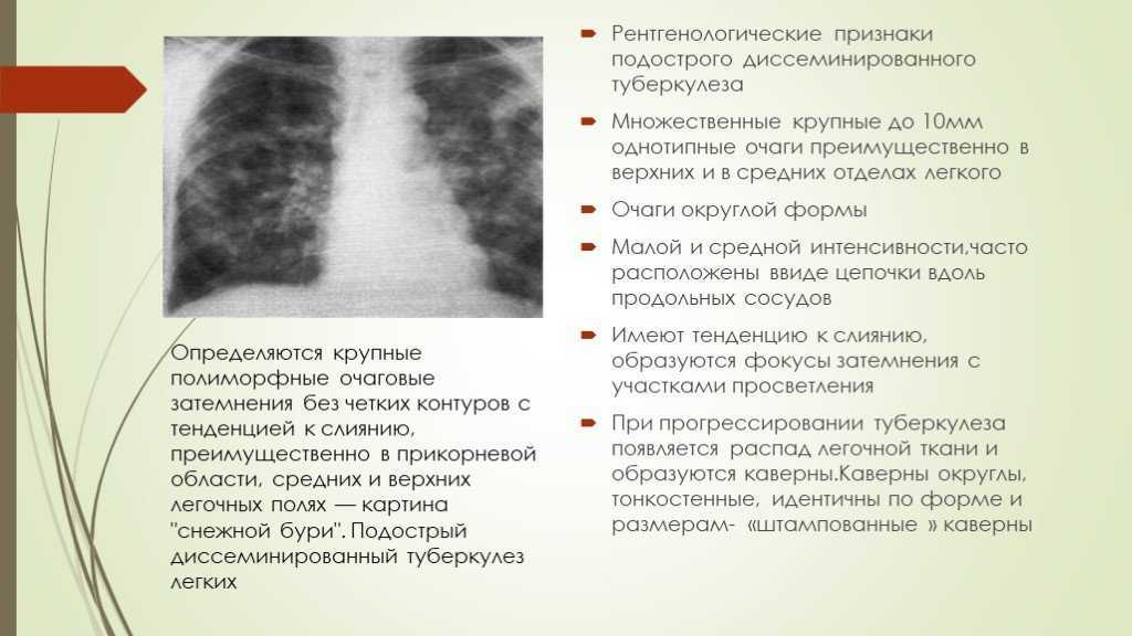 Диссеминированный туберкулез легких - симптомы, последствия, методы диагностики