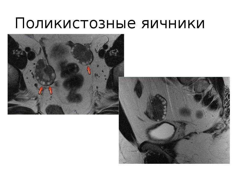 Как выглядит поликистоз яичников фото