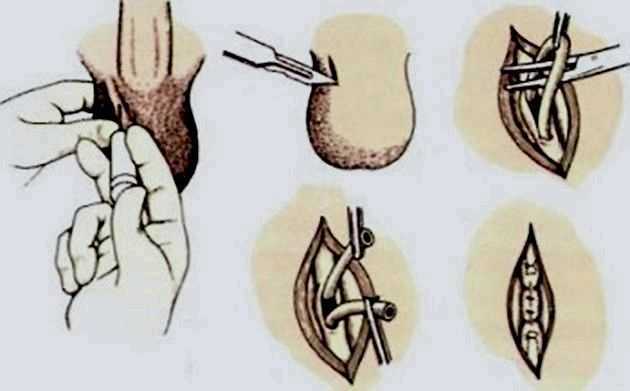 Обрезание у мужчин схема
