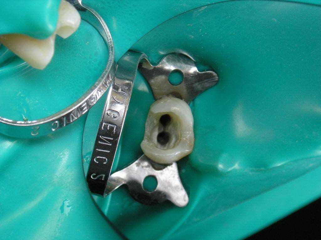 Пломбирование каналов зубов