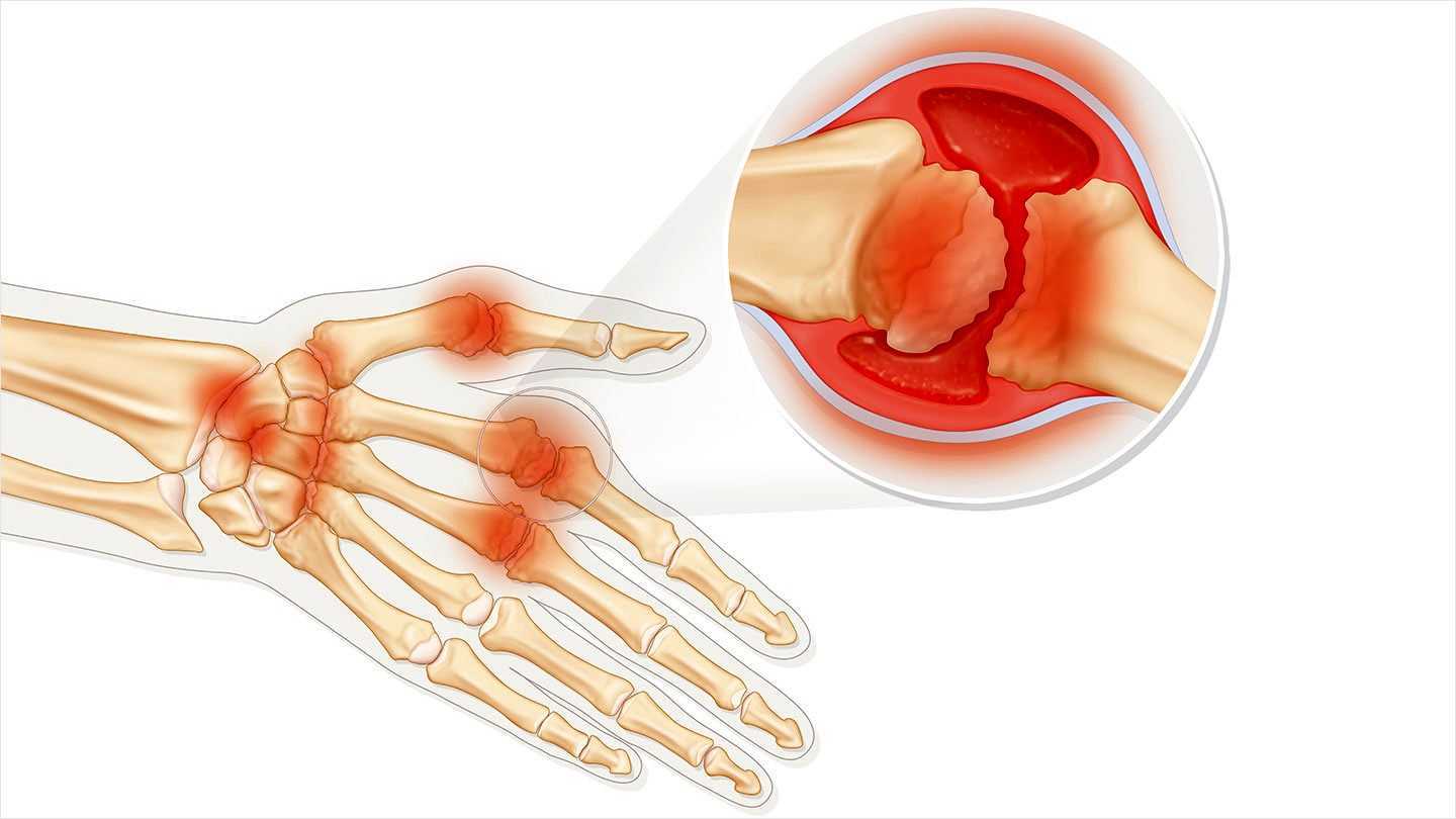 Ревматоидный артрит сустава запястья