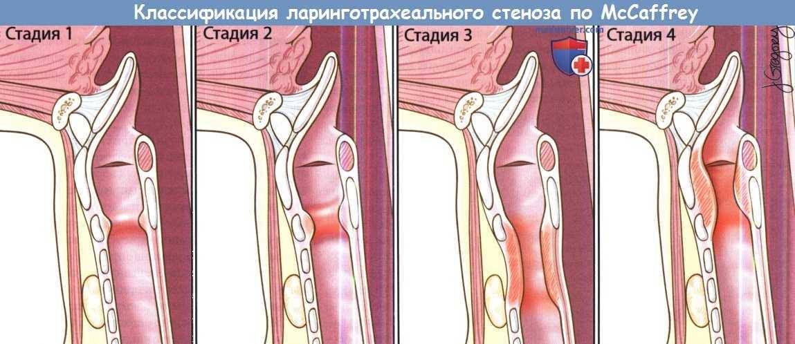 Лечение поврежденных связок голеностопного сустава: лекарства и хирургия