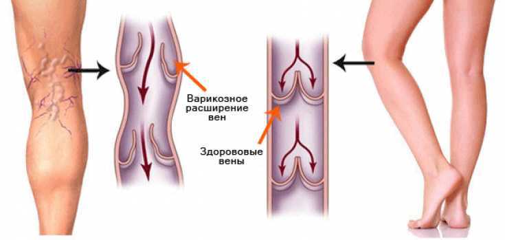 Верхняя и нижняя полые вены: система, строение и функции, патология