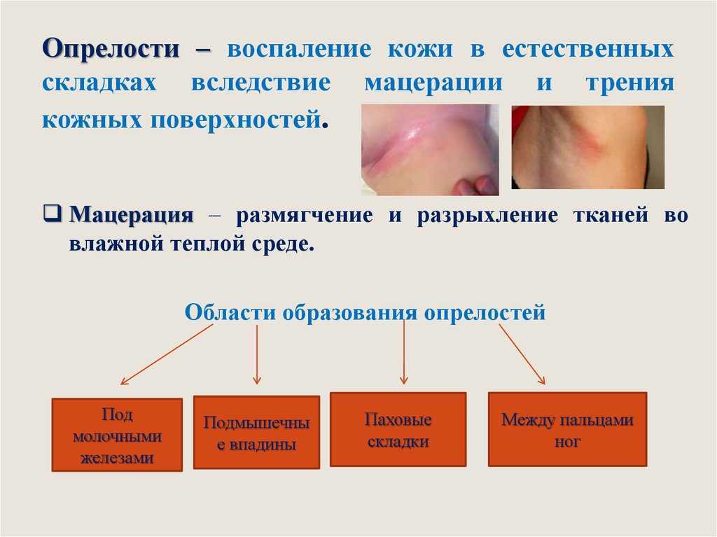 Профилактика опрелостей картинки