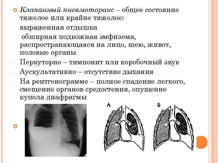 Клиническая картина открытого пневмоторакса